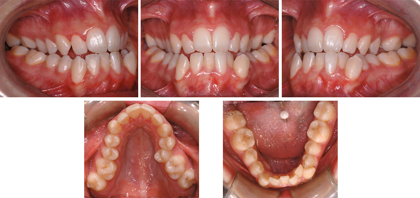 Occlusion croisée postérieure bilatérale; contraction importante de la mâchoire supérieure