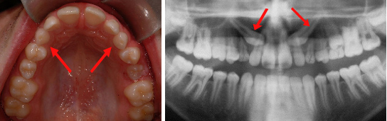 Radiographie et photo montrant la position des canines au palais (indiquées par les flèches).