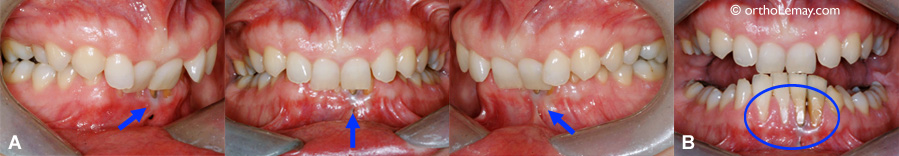 Usure dentaire et de gencive avec malocclusion importante