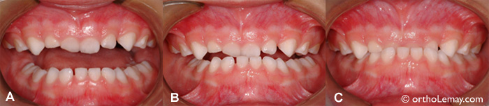 Malocclusion dentaire; occlusion croisée classe 3
