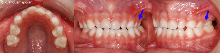 Occlusion croisée postérieure en dentition temporaire (garçon de 5 ans). Cette condition persistera en dentition permanente