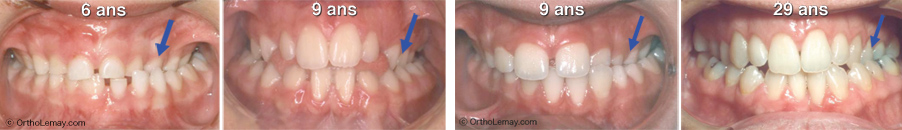 Posterior crossbite that was not corrected without an orthodontic treatment.