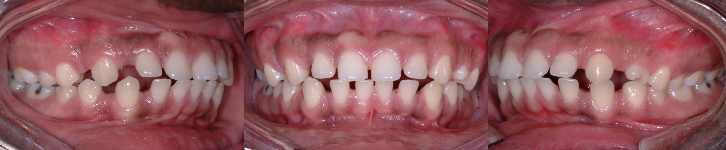 Espaces excessifs entre les dents