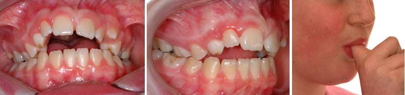 Exemple de l'effet à long terme sur la dentition. Jeune fille de 12 ans ayant sucé son doigt plusieurs années; béance antérieure, contraction et déformation de la mâchoire supérieure, dents supérieures avancées.