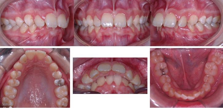 Malocclusion "Classe 2" avec dents supérieures avancées et dents inférieures qui mordent dans le palais