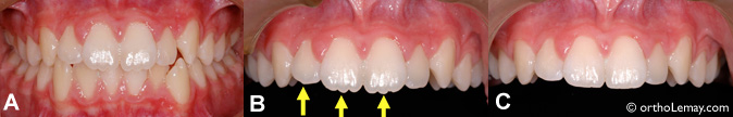 Dentelle dentaire, irrégularités du bord incisif et polissage de la dent.