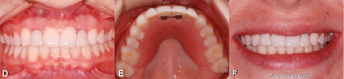 Prothèse partielle amovible pour remplacer temporairement des incisives latérales manquantes avant la pose d'implants dentaires. 