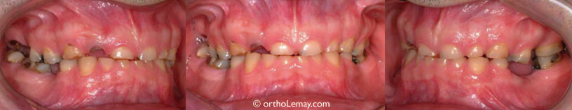 Usure sévère chez un homme de 39 ans ayant une habitude de bruxisme (grincement de dents) et ayant une forte musculature de mastication. Les dents s'effritent progressivement et commencent à être affectées par la carie.
