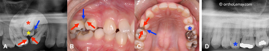 Dents ankylosées et submergées suite à une mauvaise supervision pendant l'éruption dentaire.