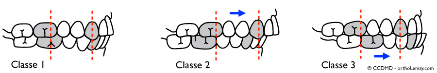 DIagramme de classification d'Angle des malocclusions dentaires