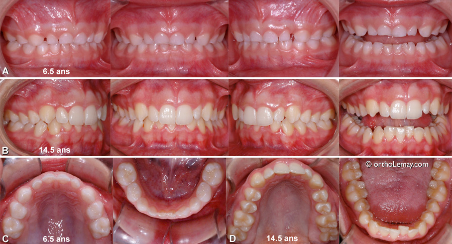 malocclusion classe 1 classe 2 persiste avec l'âge et la croissance et ne se corrige pas.