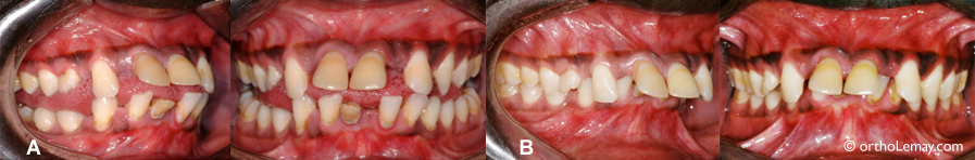 Béance antérieure et déglutition atypique, malocclusion dentaire