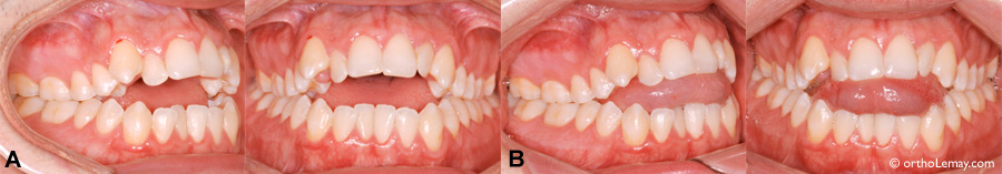 malocclusion dentaire béance antérieure et pressin de la langue