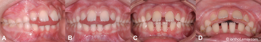 Béance antérieure et pression de langue, espaces inter-dentaires.
