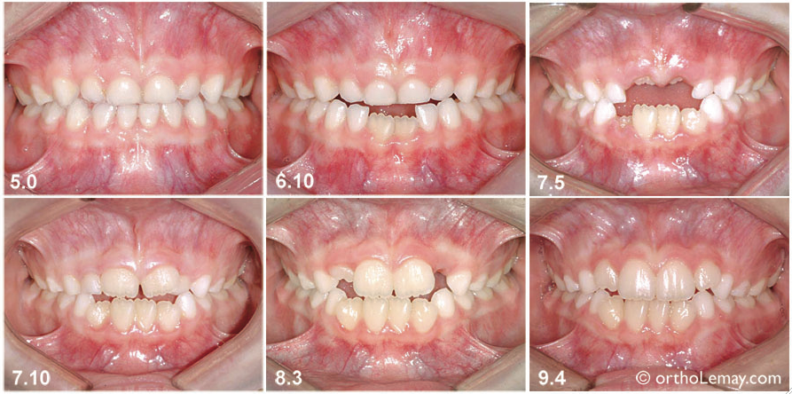 Étapes du développement dentaire relativement normal chez une fille entre l'âge de 5 et 10 ans. À mesure que les incisives permanentes sortent, il y a moins d'espace pour que la langue se place entre les dents antérieures. 