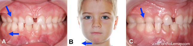 Occlusion croisée postérieure avec déviation mandibulaire