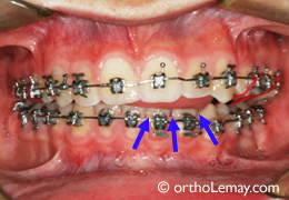 Pression de langue et béance pendant l'orthodontie