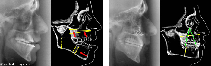 Radiographies avant et après la chirurgie et diagrammes illustrant les mouvements effectués sur les mâchoires