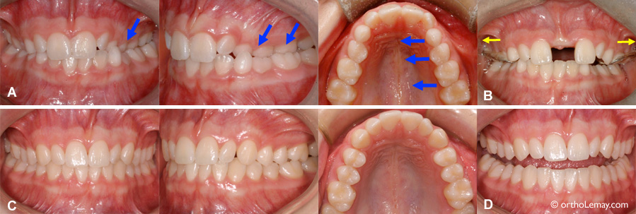 Expansion palatine rapide et correction de malocclusion orthodontie Sherbrooke