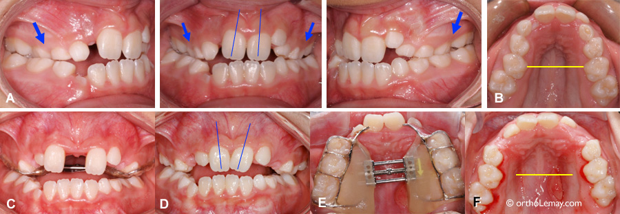 Rapid maxillary expansion in orthodontics and improved palatal width