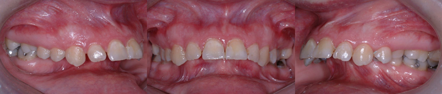 Rétrognathie mandibulaire sévère (mâchoire inférieure reculée) chez une patiente de 31 ans