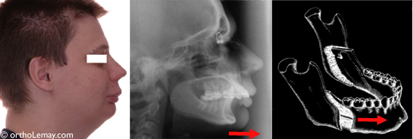 Profil avec menton reculé. La radiographie montre une mandibule trop courte et reculée qui contribue à l'écart important entre les dents du haut et celles du bas. Le diagramme montre le mouvement qui doit être effectué en chirurgie pour avancer la mâchoire.
