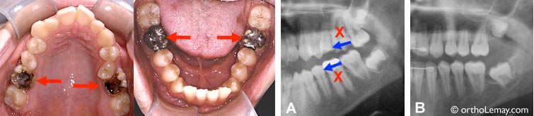 Cas où 4 molaires sévèrement endommagées ont été extraites (flèches rouges et X) pour éviter des travaux dentaires importants (traitements de canal et couronnes). Les espaces de la largeur d'une molaire (±11 mm) ont été fermés (flèches bleues) évitant d'avoir à remplacer les dents extraites. Radiographies : A. Avant les extractions. B. après l'orthodontie, une fois les espaces fermés (côté gauche).