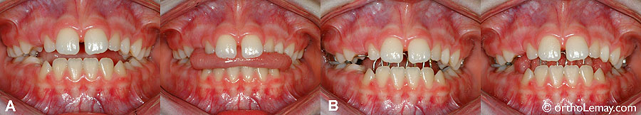 (A) En présence d'une béance antérieure, la langue se place entre les dents lors de la déglutition (avaler) pour fermer l'ouverture entre les dents. (B) Lorsqu'un écran oral est mis en bouche, l'appareil agit comme une "clôture" qui bloque la langue et l'empêche d'exercer une pression sur les dents. Ceci peut aussi servir à bloquer un pouce ou un doigt.