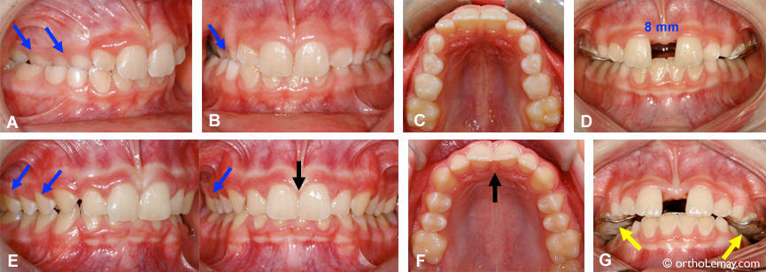 Opening of a space during the rapid maxillary expansion in orthodontics