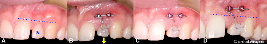 Éruption forcée ou égression dentaire en orthodontie d'une dent fracturée