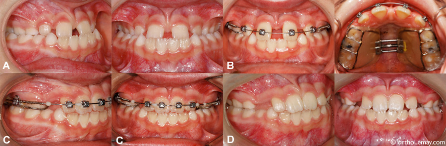 Orthodontic maxillary expansion and braces