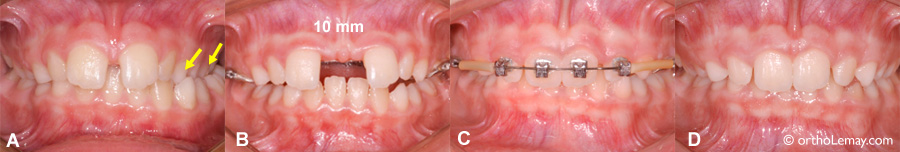 Diastème important ouvert pendant l'expansion maxillaire rapide.