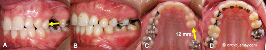 Fermeture d'espace d'extraction en orthodontie. 