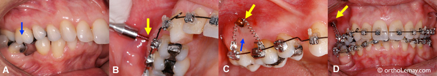 Intrusino de dents postérieures à l'aide d'une mini-vis d'ancrage temporaire TAD