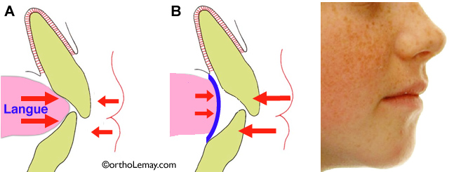 Action de la langue et des lèvres sur les dents et une malocclusion dentaire