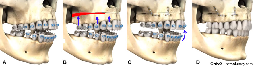 Impaction maxillaire chirurgie orthognathique et orthodontie pour une béance antérieure.