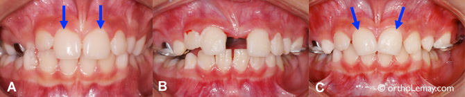 Movement of teeth during relapse of the maxillary expansion