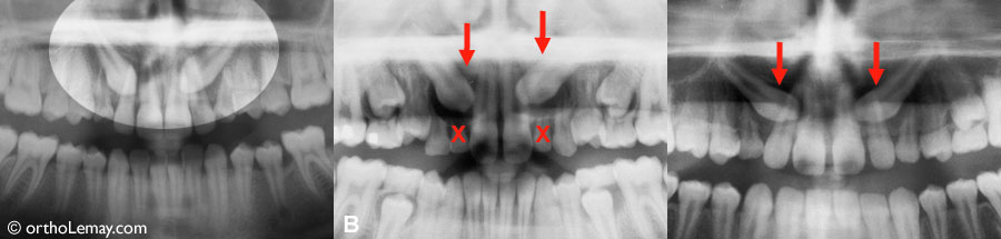 Exemples de direction anormale d'éruption de canines supérieures. Ces dents deviennent fréquemment "incluses" et se dirigent vers le palais. La radiographie (B) révèle de plus une pathologie autour des canines (kyste) et l'asence congénitale des latérales supérieures (X).