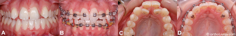 Traitement d'un manque d'espace sévère sans extractions en orthodontie