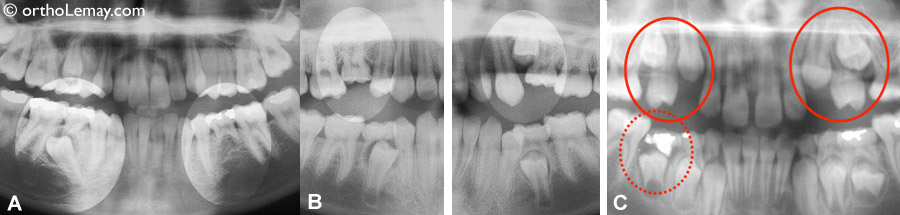 (A) Prémolaire inférieure se dirigeant vers l'arrière et absence congénitale (génétique) d'une prémolaire du côté opposé. (B) Une prémolaire bloquée, absence de 2 autres prémolaires et 2 dents temporaires ankylosées (soudées à l'os) et submergées. (C) Perte d'espace suite à la perte de dents temporaires au haut; prémolaires bloquées et incluses.