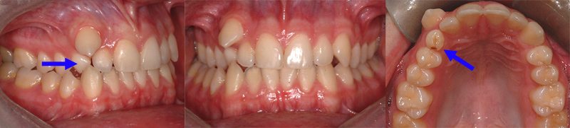 Canine permanente supérieure droite qui sort au-dessus d'une dent temporaire qui n'est pas tombée (flèche). Il est parfois indiqué d'extraire des dents temporaires pour faciliter l'éruption des dents permanentes.