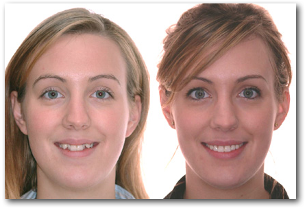 Sourire CC 043228 S orthodontiste Lemay Sherbrooke