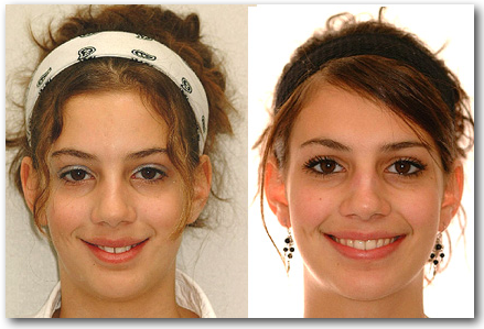 Sourire CE 021027 S Orthodontiste Jules Lemay Sherbrooke
