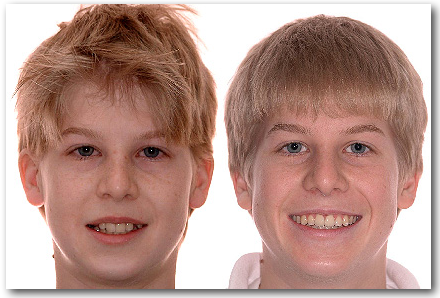 Sourire FRousseau 053323 S orthodontiste Jules Lemay Sherbrooke