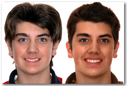 Sourire SPG 053285 S Orthodontiste Lemay Sherbrooke