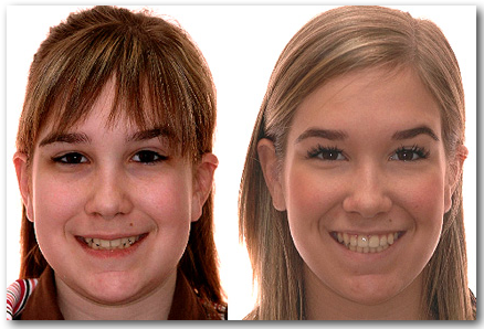 Sourire smile SYS 053193 S Jules Lemay Orthodontiste Sherbrooke