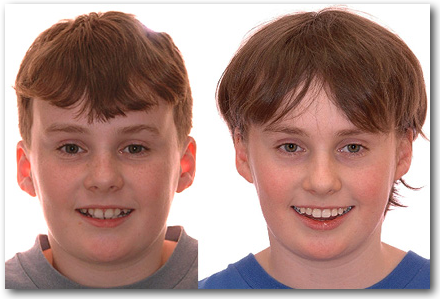 Sourire  TS 063216 S Orthodontiste Jules Lemay Sherbrooke