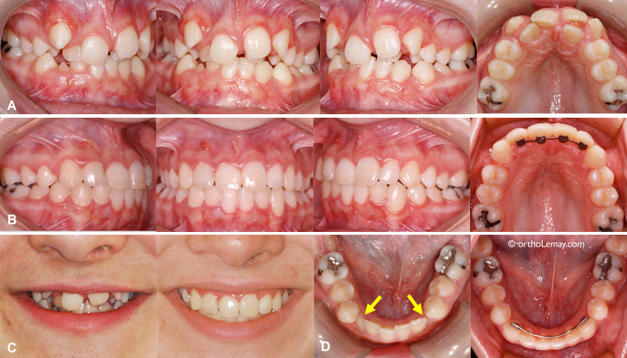 malocclusion dentaire avec manque d'espace sévère traitée en orthodontie sans extractions 
