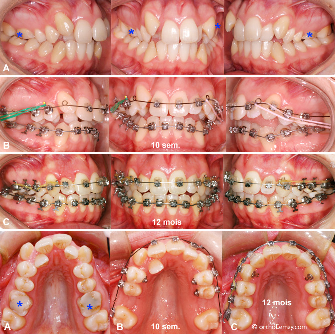 Expansion dentaire et extractions en orthodontie. Fermeture d'espace.