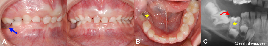 probleme eruption dentaire malocclusion ankylose orthodontie sherbrooke 536543 AG6.7 copy copy L'ankylose dentaire peut mener à différents problèmes d'éruption. Une radiographie peut aider à déceler ces problèmes.